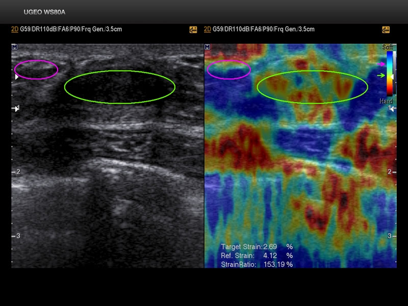 Молочная железа, эластография