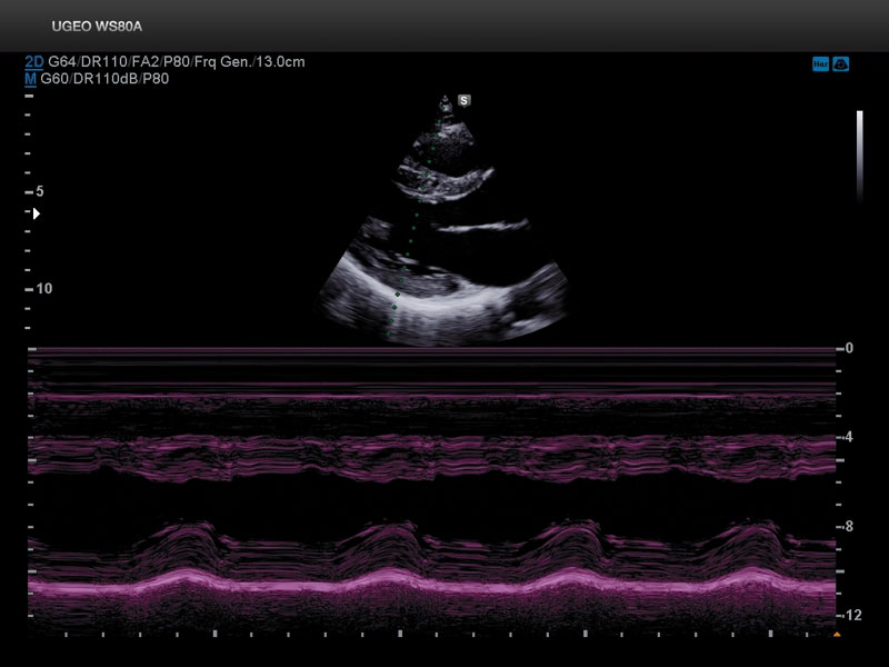 Сердце, левый желудочек, M-режим