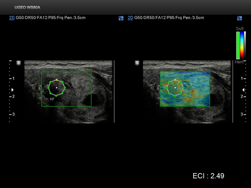 Щитовидная железа, эластография